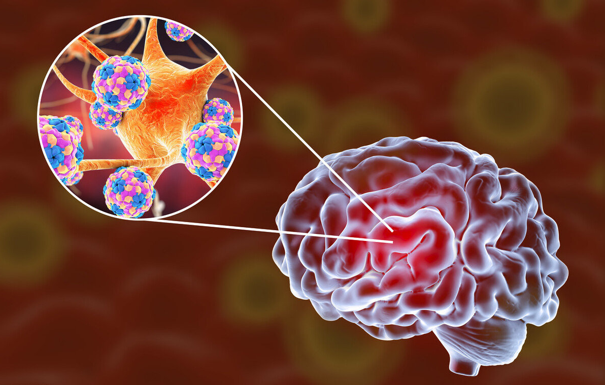 文献解读|Adv Sci（15.1）：大规模蛋白质组分析鉴定与疑似神经梅毒诊断相