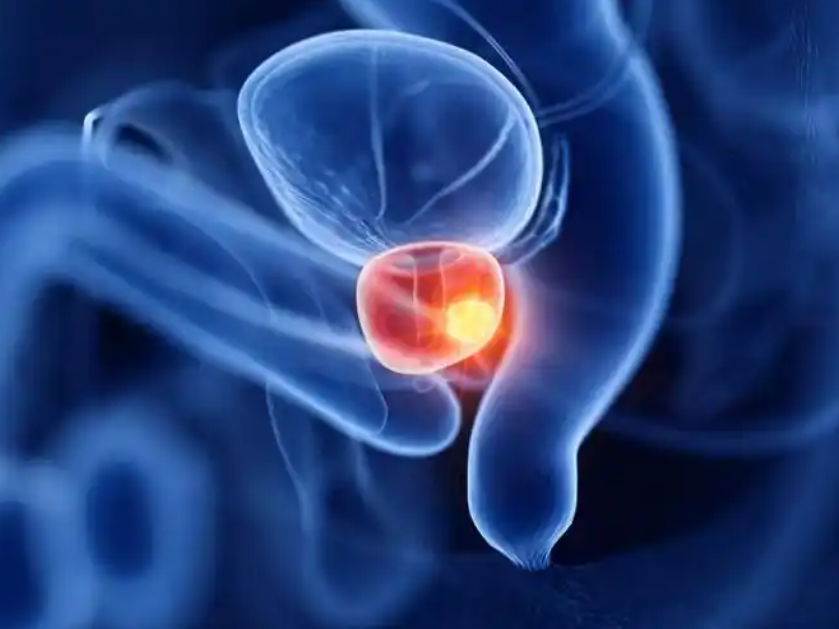 文献解读|Nat Cancer（23.5）：中国患者高风险前列腺癌样本的综合蛋白