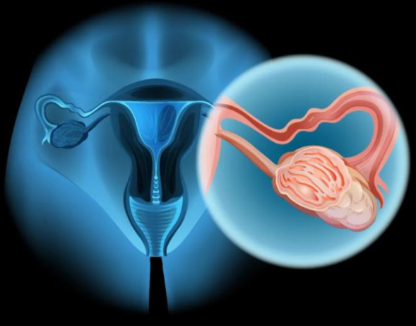 文献解读|Nat Commun（14.3）：上皮性卵巢癌的蛋白质组学图谱