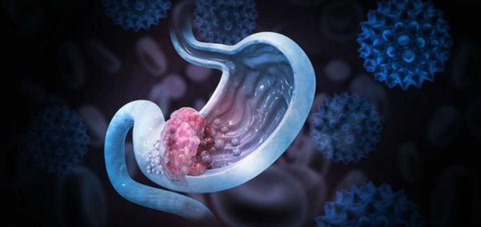 文献解读|Cell Discov（13.0）：壶腹部腺癌的综合蛋白质组学表征