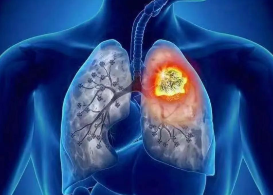 文献解读|Nat Commun（14.7）：蛋白质组学表征揭示了表现为亚实性结节