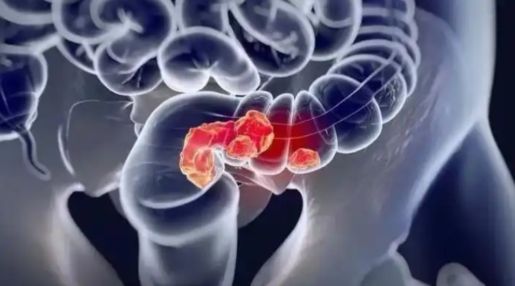 文献解读|Cell Rep Med（11.7）：肿瘤和血浆细胞外囊泡的综合蛋白质