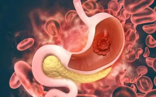 文献解读|Cancer Cell（44.5）：剖析胃癌新辅助免疫化疗异质性反应的